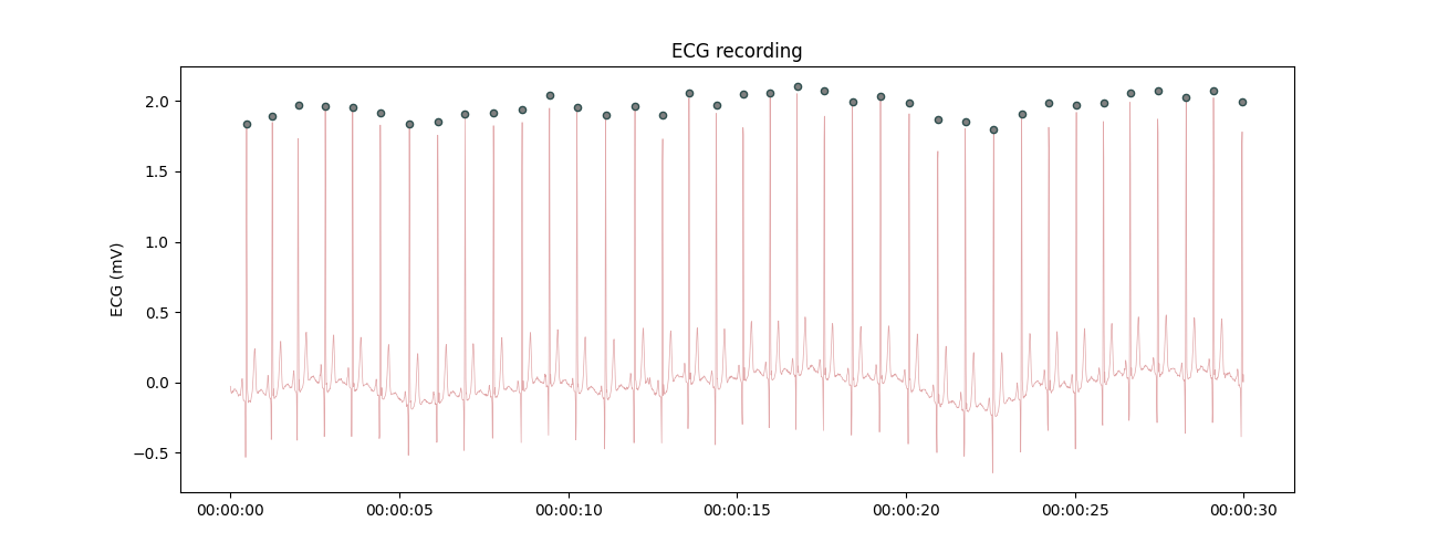 ECG recording